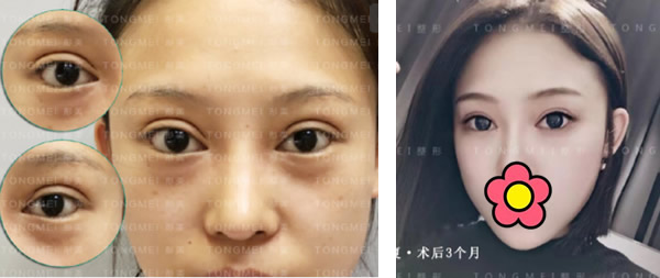 劉鳳卓修復(fù)雙眼皮案例
