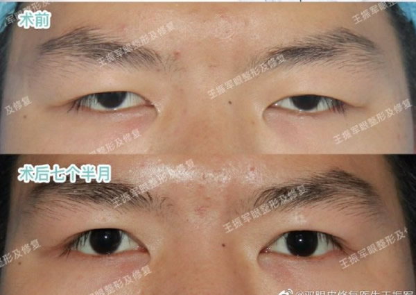 王振軍雙側(cè)重度上瞼下垂矯正前后對比照片