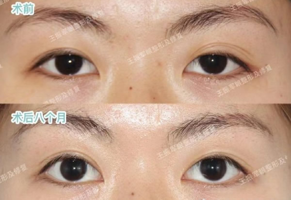 北京王振軍多層眼皮+內(nèi)眥贅皮修復(fù)效果