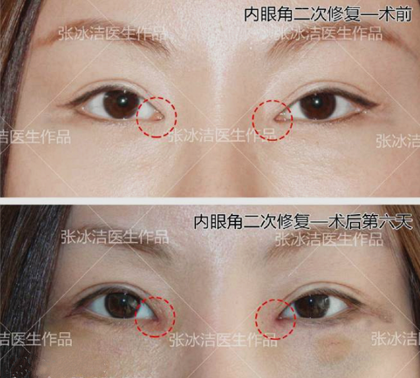 張冰潔修復內眼角案例