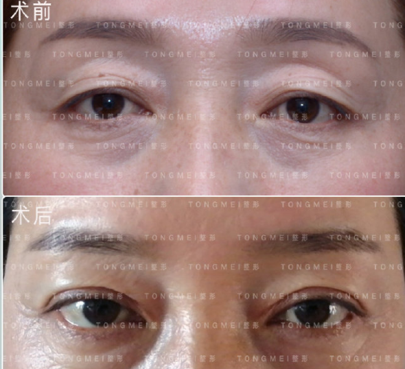 北京劉風卓雙眼皮修復案例