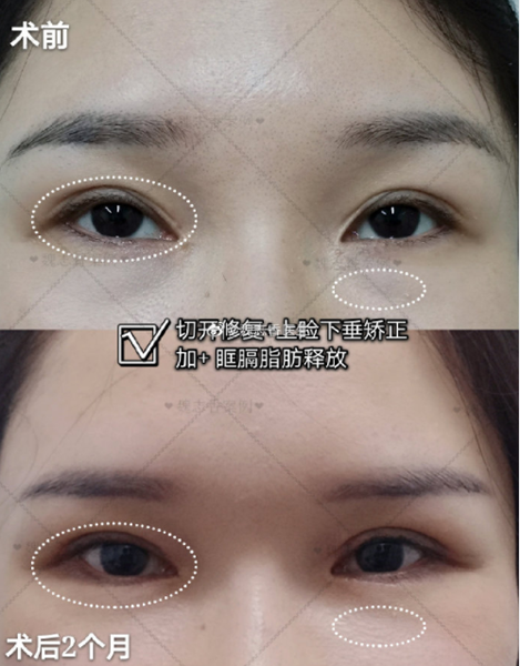 魏志香雙眼皮修復怎么樣