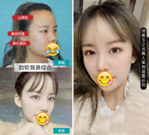 郝勁偉醫(yī)生做肋軟骨鼻綜合案例效果對比圖