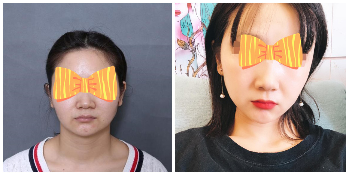 北京圣嘉榮黃大勇磨骨案例