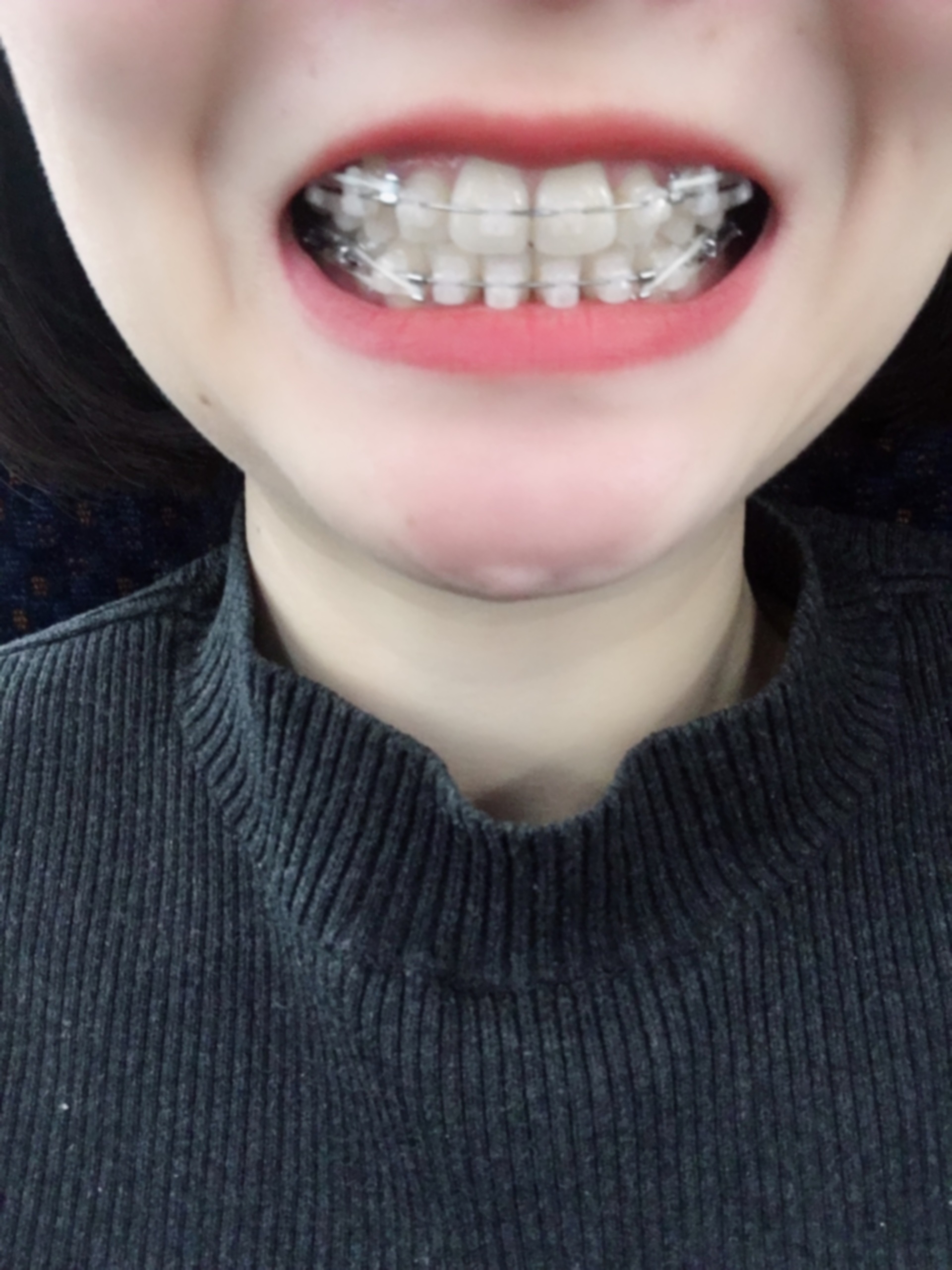 18岁了戴牙套还有用吗