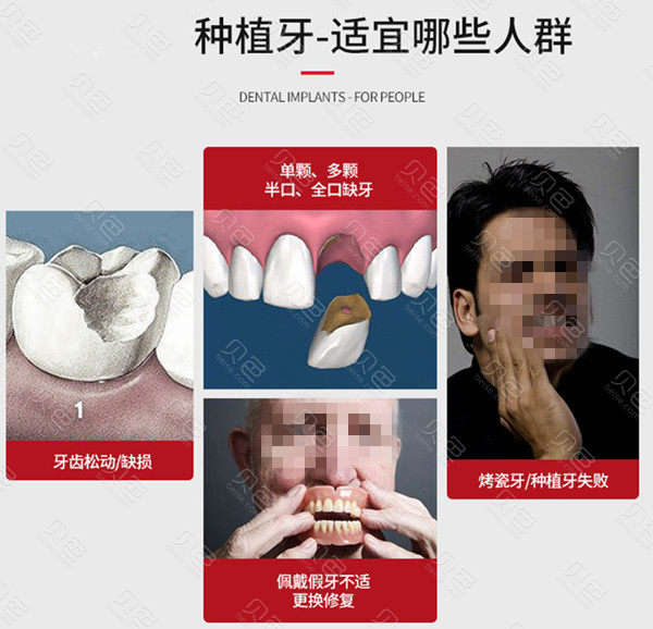 佛山種植牙誰家最便宜?佛山重點榜單重點十家醫(yī)院相對比哪家價格實惠技術好