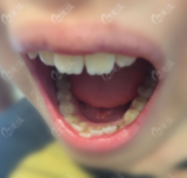 9歲兒童大門牙矯正多少錢痛嗎???需多久