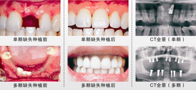 广州天河区牙齿矫正谁家医院做的不错?鹏爱口腔、牙博齿科、领航口腔等医院技术超棒