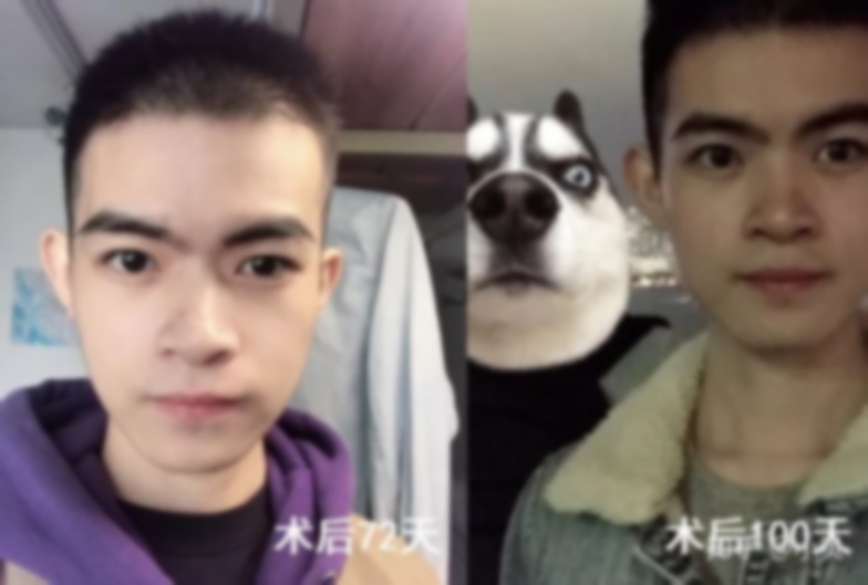 四十歲正頜手術(shù)還有必要嗎?五十歲可以做正頜手術(shù)嗎?30歲正頜手術(shù)