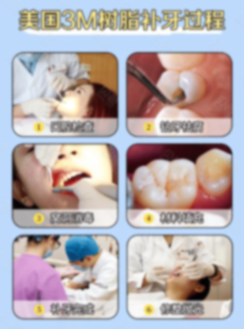 3m树脂补牙p60价格,怎么样?能用多久 3m树脂补牙p60价格,怎么样?能用多久