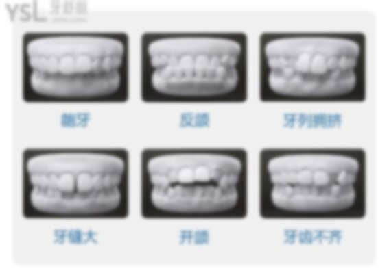牙齒矯正33歲可以嗎?33歲可以矯正牙齒嗎?33歲做牙齒矯正后悔的嗎?