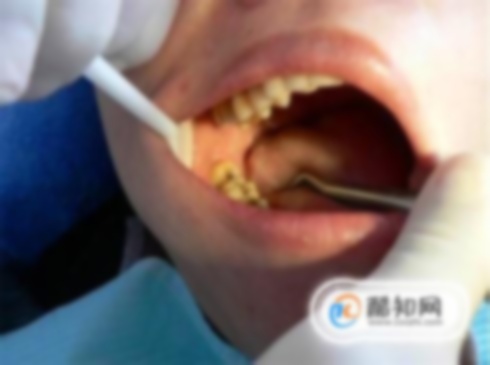 微創(chuàng)拔智齒好嗎?和傳統(tǒng)拔智齒區(qū)別,和普通拔智齒的區(qū)別