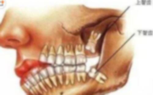 拔智齒一年半碰到?jīng)鏊€痛,完智齒含涼水就不痛,智齒碰涼水就疼