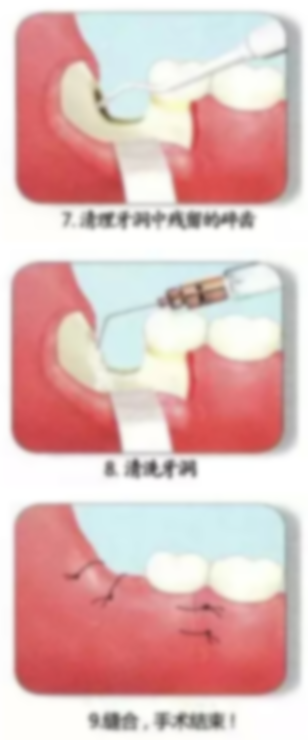 智齒拆線怎么拆視頻?拔智齒后拆線視頻,口腔智齒拆線視頻
