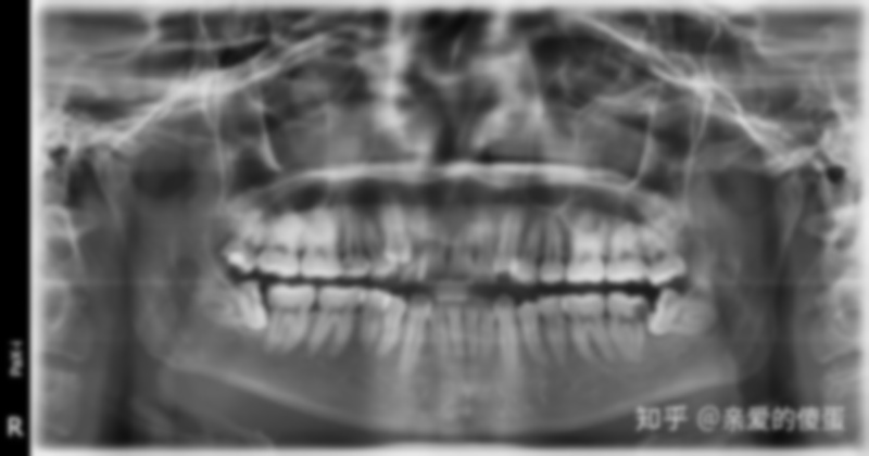 拔兩顆智牙多少錢?上智齒多少錢?了兩顆智齒多少錢?