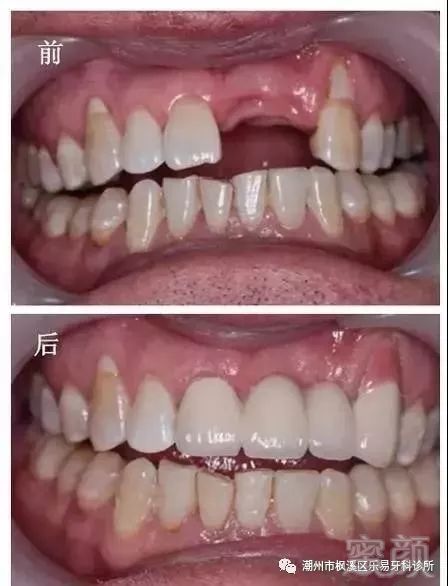 深圳寶安區(qū)在哪兒做烤瓷牙不錯?為您十分推薦深圳寶安區(qū)烤瓷牙做的不錯的 醫(yī)院