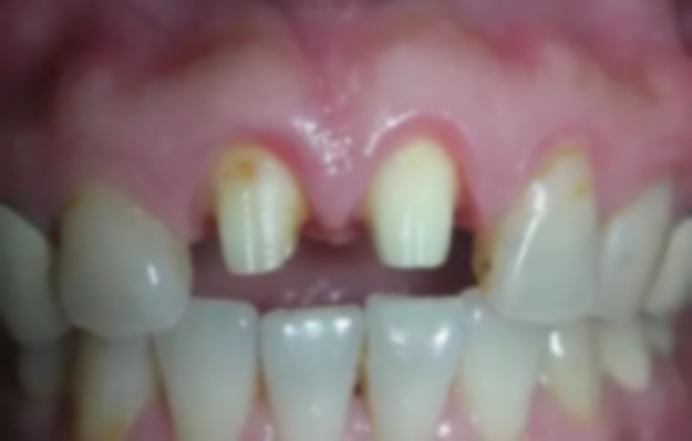 齙牙能把門牙磨小做烤瓷牙嗎?磨小做烤瓷好看嗎?牙齒磨小做烤瓷牙