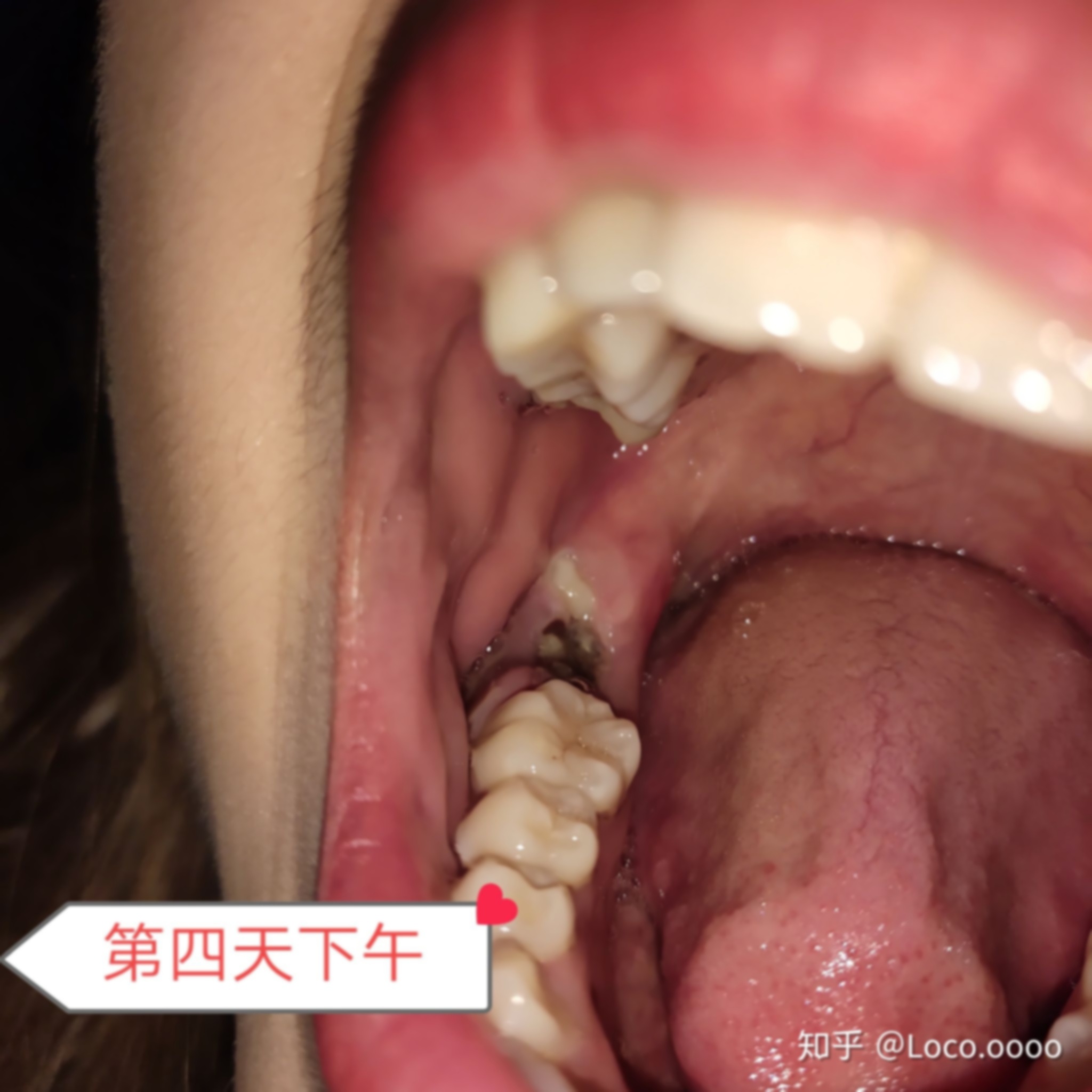 拔牙后出血如何止血,出血嚴(yán)重如何止血,怎么止血?