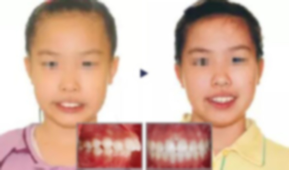 31歲有必要矯正牙齒嗎?32歲矯正牙齒的危害,32歲矯正牙齒的利與弊