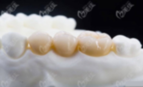 愛(ài)爾創(chuàng)全瓷牙冠質(zhì)量怎么樣?牙質(zhì)保,牙質(zhì)量如何?