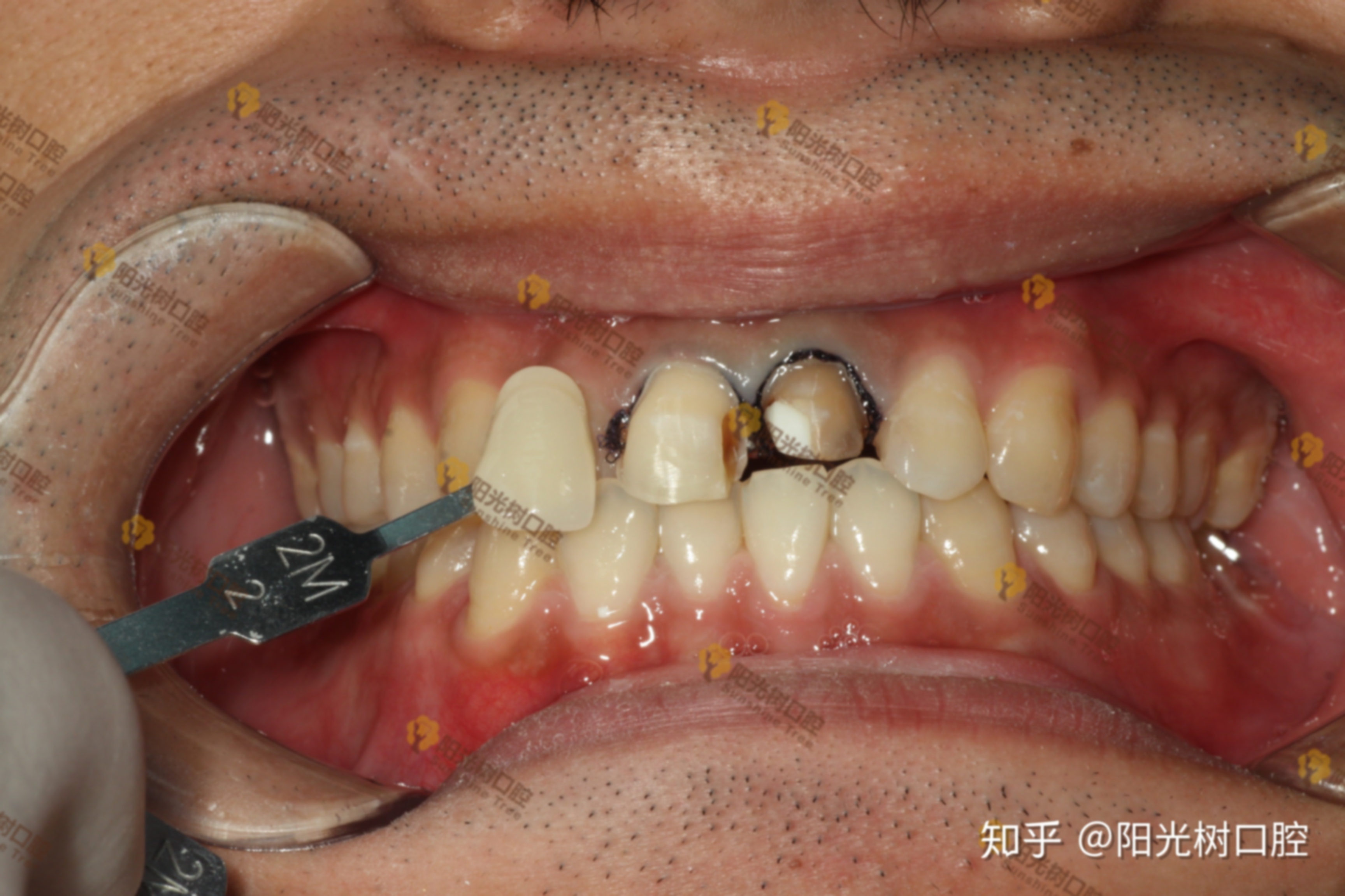 拔完牙之后多久可以做烤瓷牙,牙后多久可以做烤瓷牙牙,牙后最快多久可以做烤瓷牙