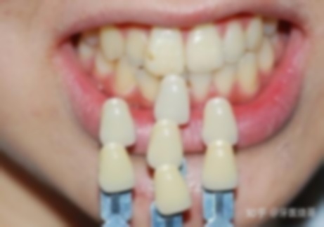 牙齒拔除后多久可以裝假牙,拔了以后多久可以裝假牙,牙拔掉后多久可以裝假牙