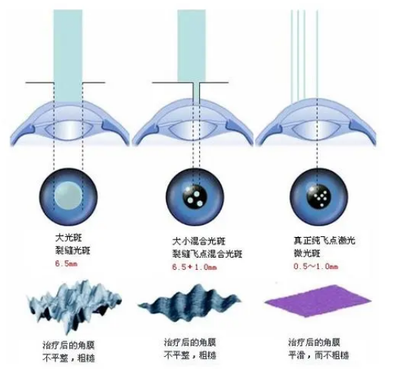 重庆准分子激光手术费用区间1万到3万元左右及维持多久