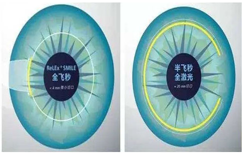 全飛秒幾歲才能做？全飛秒手術(shù)必須滿18歲才能做嗎？
