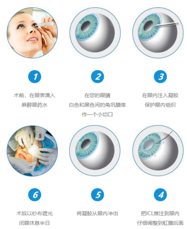 icl晶体植入术多少钱|icl晶体植入浮动价格2万元-3万元