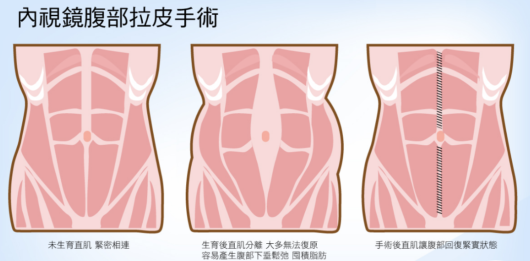 腹部拉皮手术费多少钱