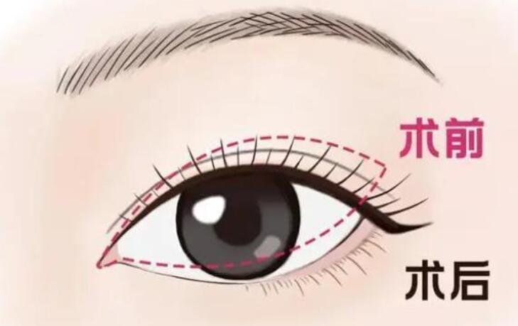雙眼皮術前術后