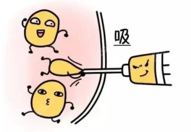 冯斌和其他医生吸脂技术上的区别