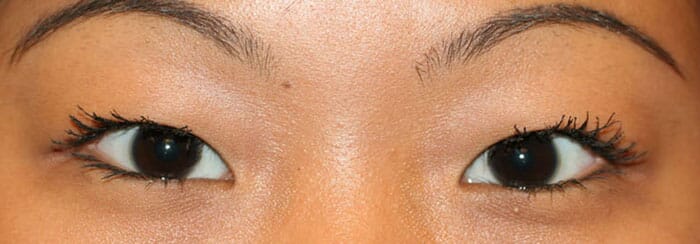 双眼皮修复需要2-3个月的时间